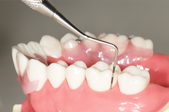 [写真]歯周組織検査
